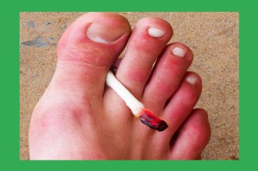 medical marijuana for gout bloq, feature image, joint between swollen toes, Don’t Be Scared Of Medical Marijuana For Gout!